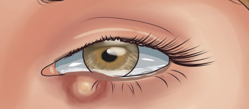 Calázio no olho - causas, sintomas, tratamento, cirurgia